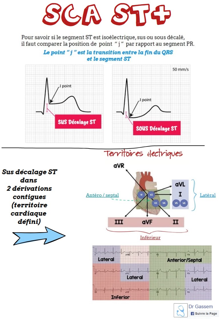 SCA ST+ et territoires cardiaques